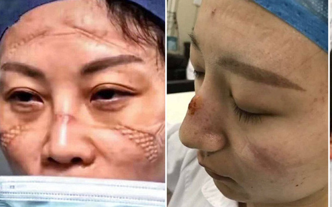 Gương mặt đầy vết hằn do khẩu trang, kính bảo hộ: Các y tá, bác sĩ ở Vũ Hán đã đánh cược cả tính mạng để chống lại đại dịch corona